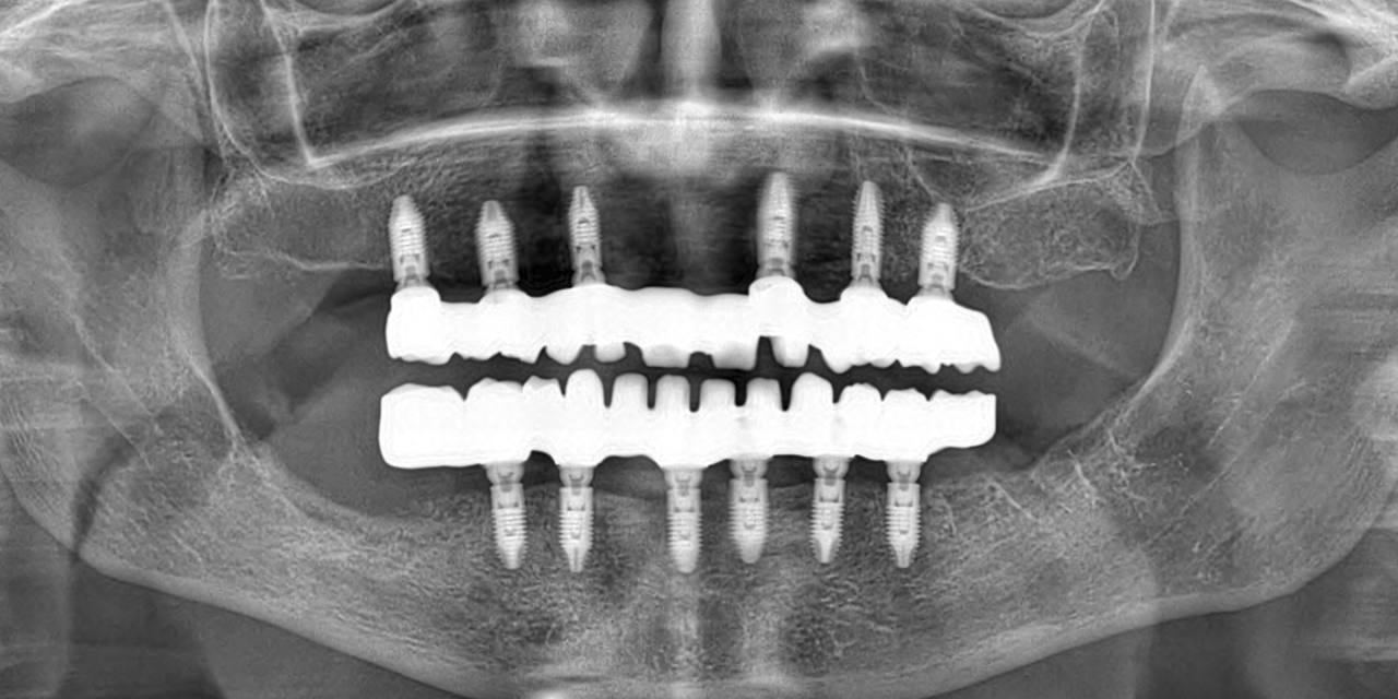 IMPLANTOLOGIA